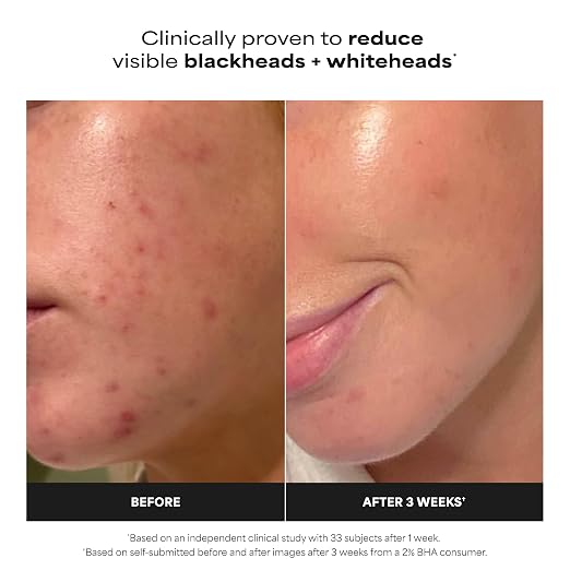 Paula’s Choice Exfoliate 2% BHA Skin Perfecting Exfoliant – 118 mL / 4 fl oz